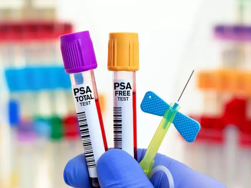 prostat-tarama-testleri